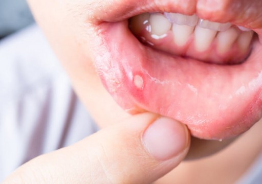 5 طرق طبيعية وفعالة لعلاج تقرحات الفم