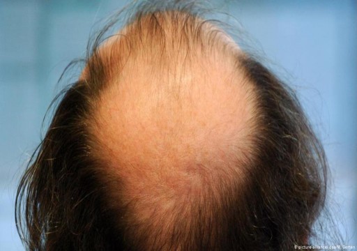 كيف يؤثر التوتر والإجهاد على صحة الشعر؟