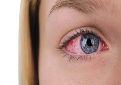 جفاف العيون.. الأسباب والأعراض وكيفية علاجه