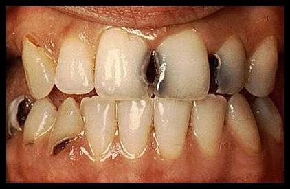  أكثر من 2,4 مليار شخص في العالم مصابون بتسوس الأسنان